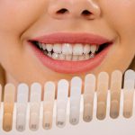 How Veneers Can Improve Light Reflection for a More Youthful Appearance