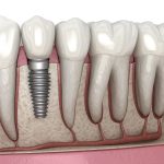 How Guided Bone Regeneration Techniques Enable Dental Implant Success in Patients with Insufficient Jawbone Density