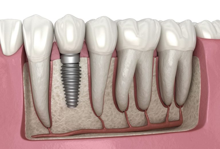How Guided Bone Regeneration Techniques Enable Dental Implant Success in Patients with Insufficient Jawbone Density