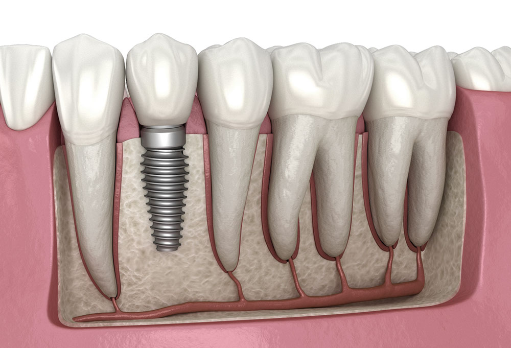 How Guided Bone Regeneration Techniques Enable Dental Implant Success in Patients with Insufficient Jawbone Density
